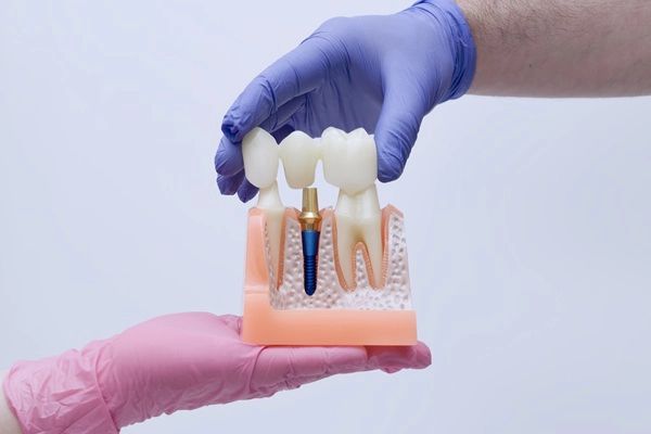 Why Dental Bridges Are An Effective Tooth Restoration