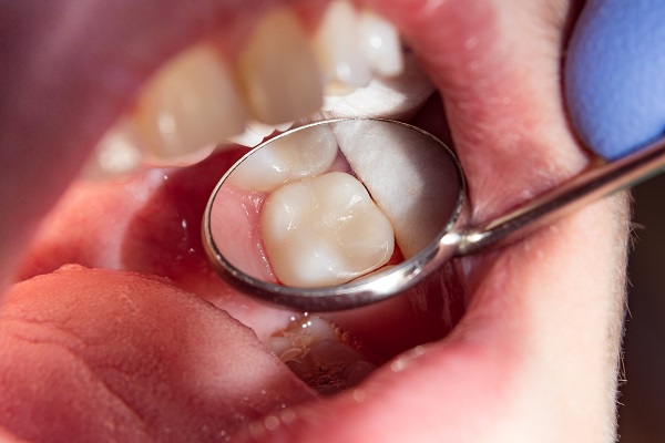 What Happens During A Dental Filling Procedure?