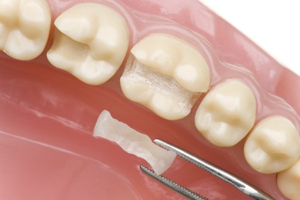 Benefits Of Dental Sealants For Teeth