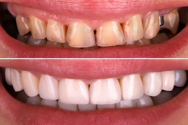 A Guide To Getting A Smile Makeover From A Dentist
